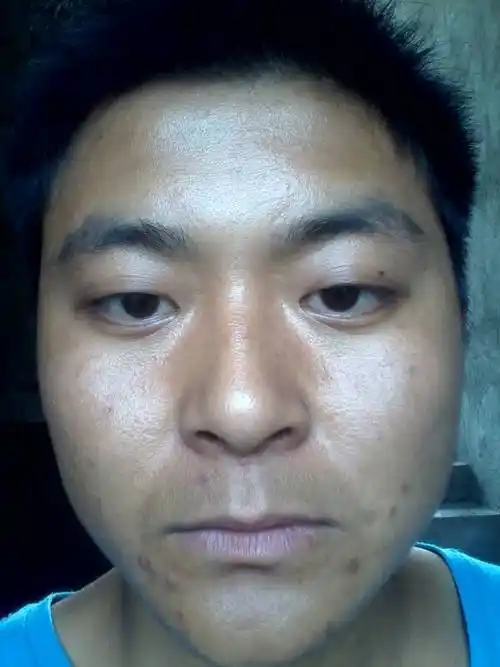 脸上很难看容易上火怎么办?男23岁