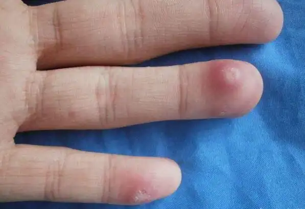 一例十分特殊的病例:以红色结节为表现的肺结核