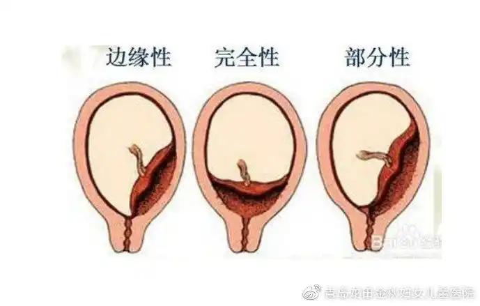 胎盘位置低怎么办怎么预防胎盘前置