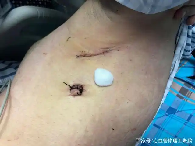 简单先天性心脏病小孩,封堵还是腋下切口?