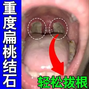 吸扁桃体结石的工具