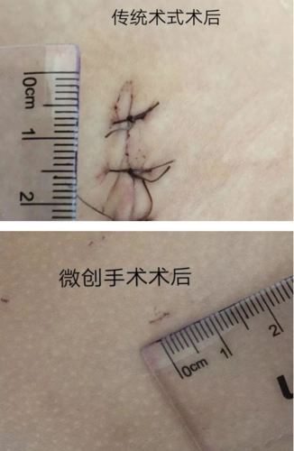 勐海县人民医院泌尿外科完成我县首例腹腔镜下鞘状突高位结扎术 - 勐