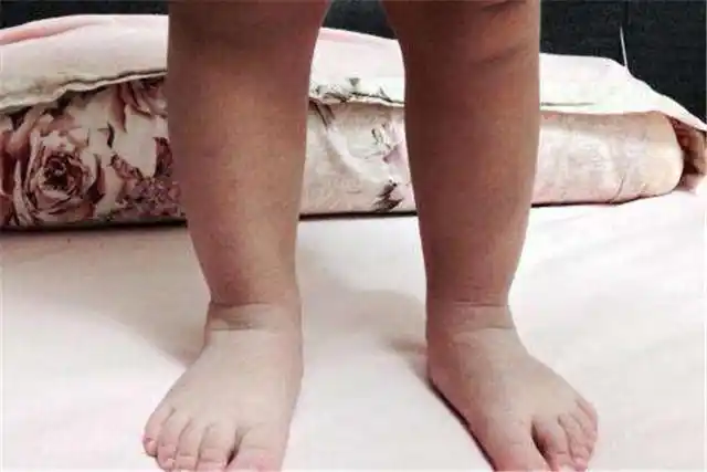 宝宝走路总摔跤外八字脚让妈妈担忧都是7个月时惹的祸