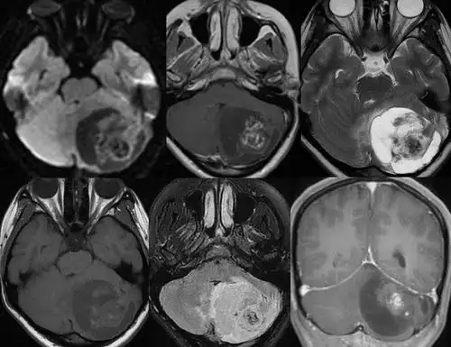 毛细胞星形细胞瘤(pa)5