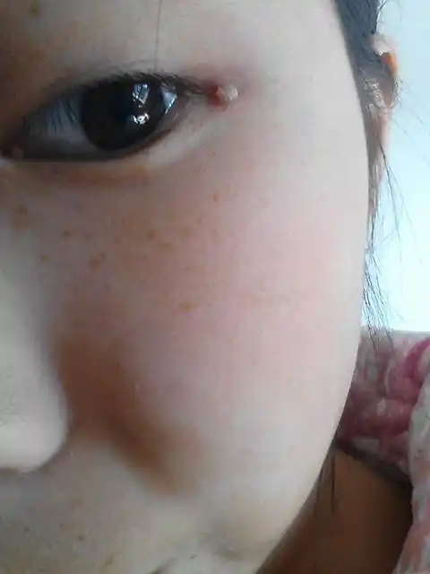 眼角长啦一个肉丁要怎么办啊?