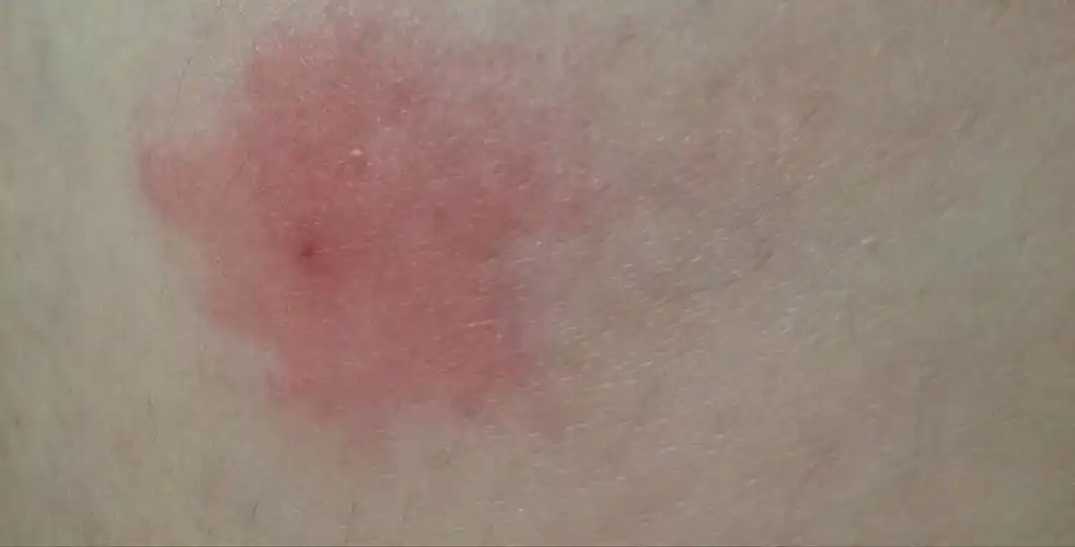 疑似被螨虫咬了太痛苦了姐妹们有什么对付螨虫的妙招吗01