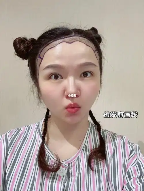 记录一下植发际线的过程(盗图必究)