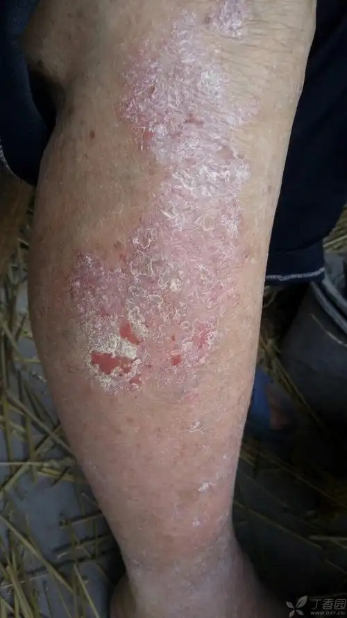 起初疮口不大,先逐渐变大趋势,是癣还是其他什么皮肤病,如何治疗,谢谢