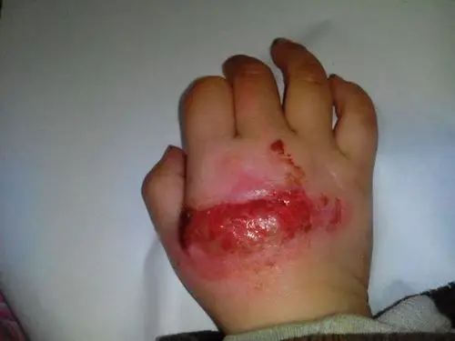 2岁小孩受伤后会怎么护理?