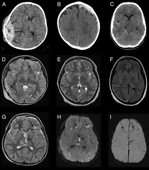医周丨头部外伤,如何判断是否出现脑震荡?又该如何应对?