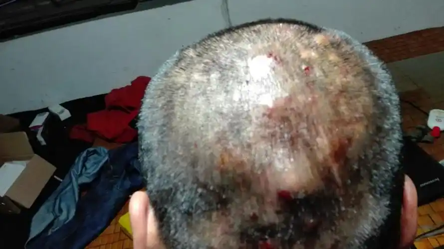 头上的痘痘都这样了还有得治嘛