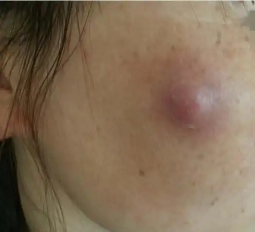 内分泌失调,表现在脸上的一种瘤子,皮脂腺囊肿是很影响一个人的外面
