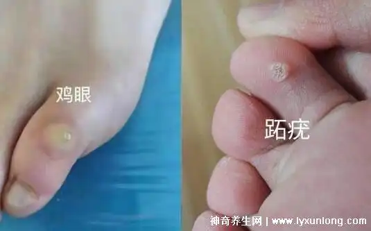 鸡眼和跖疣的区别图数量多会传染表面有黑点的是跖疣