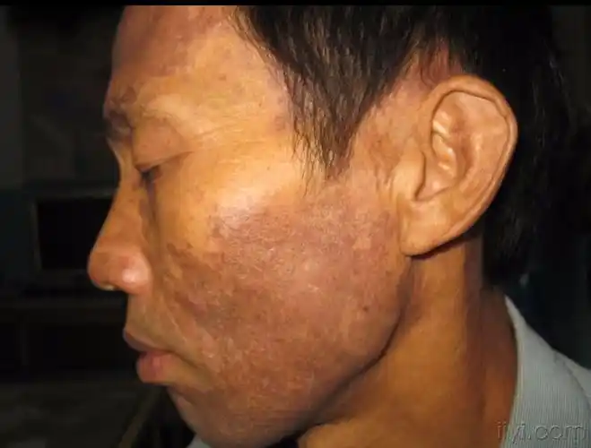 sis)是一组以好发于颜面等暴露部位的弥漫性色素沉着为特征的皮肤病