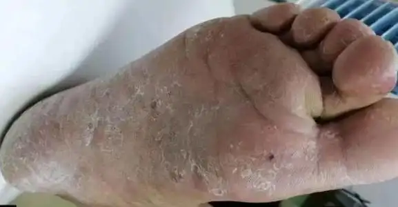 得了脚气强烈建议你试试它!用过的都说效果好!