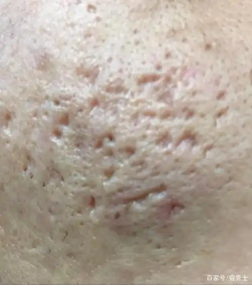 痘坑痘疤如何才能修复呢?