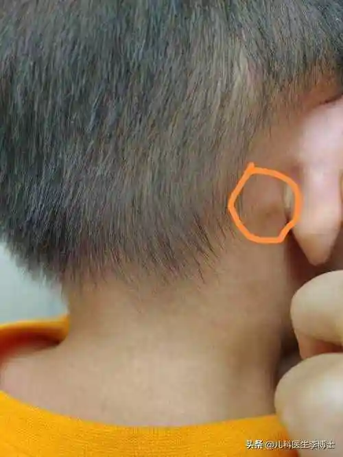 耳朵后面长了个包一按就疼怎么办耳后淋巴结会自己消吗