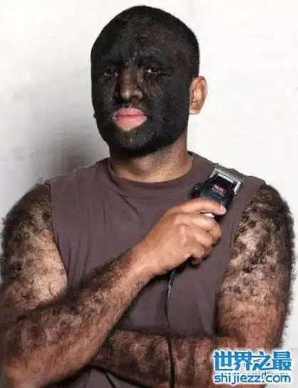 世界上体毛最长的人艾米丽·苏珊,剪了之后是个美女