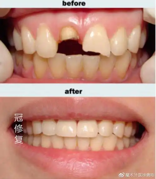 烤瓷牙该做还是不该做