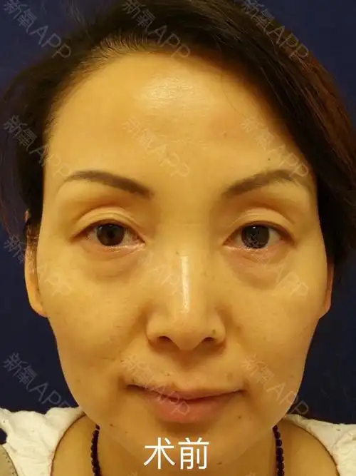 外切祛眼袋眶隔释放术后一个月效果