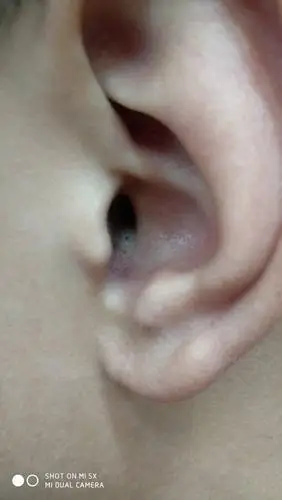耳朵里起了一个疙瘩是怎么回事