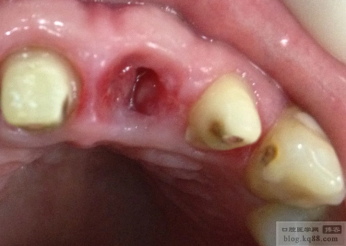 冠延长拔牙后即刻牙槽窝重塑