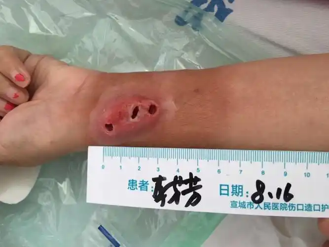 留置针针眼感染