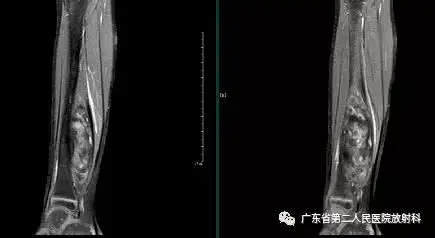 横断位软组织窗ct冠状位软组织窗,骨窗x线正侧位外院mri提示右小腿背