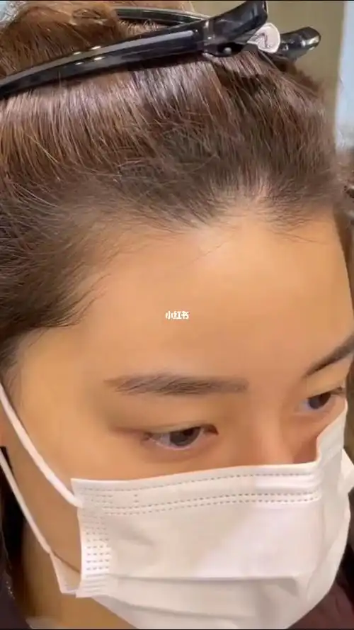 m形发际线拯救计划