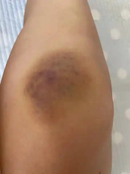 女白领亚朵酒店遭毁容店方出尔反尔协商无果