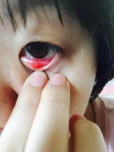 我三天前眼睛长内麦粒肿了.