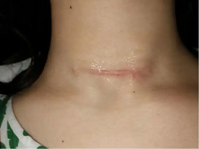 用对方法让你祛疤一劳永逸!各种疤痕都能轻松应对!