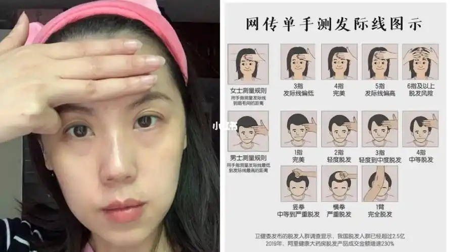 你的发际线标准吗