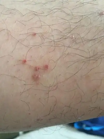 艾滋病大腿上红点图片 (44)