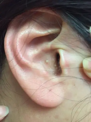 耳朵里长这种东西是为什么?这是什么东西?请懂得医生解答,谢谢