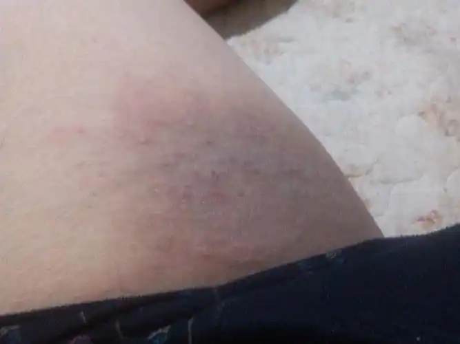 我17岁,是一名男生,在我大腿根部不知道怎么回事有乌的这种泡