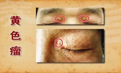 血脂高眼皮长黄包黄色瘤