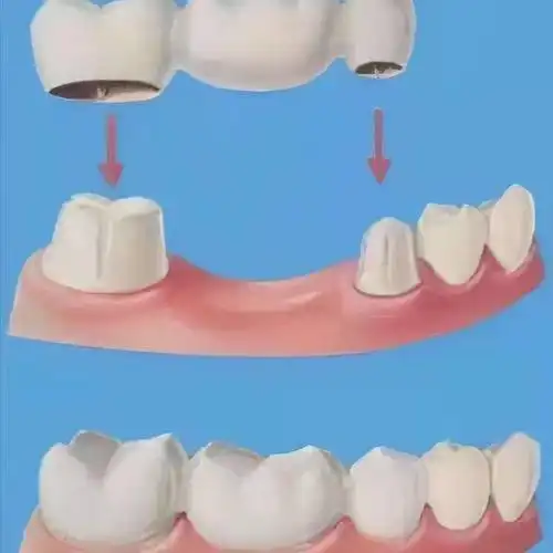 固定桥的定义及特点