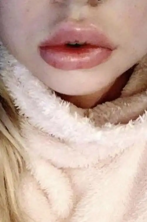 英国年轻辣妈获男友资助丰唇肿成香肠嘴发誓再不填充