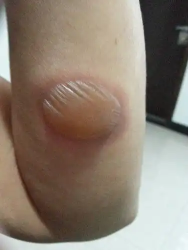 手臂开水烫伤两天,有3cm左右大,请问现在怎么办好?