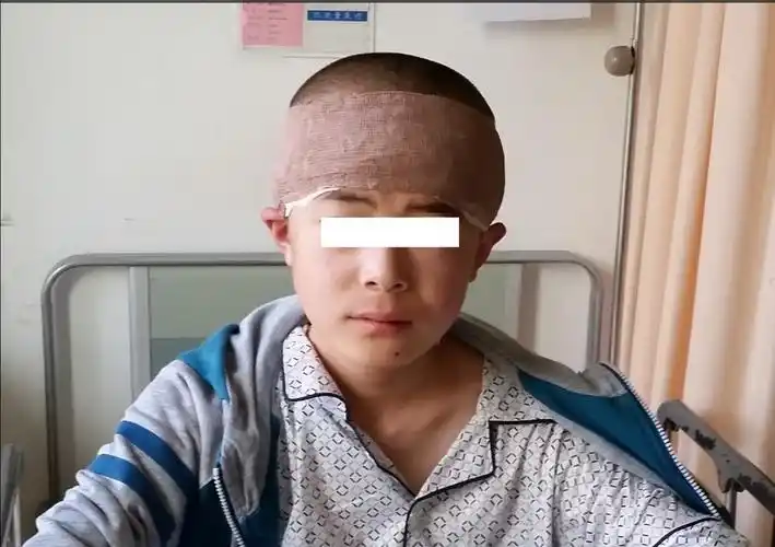 儿童髓母细胞瘤手术治疗