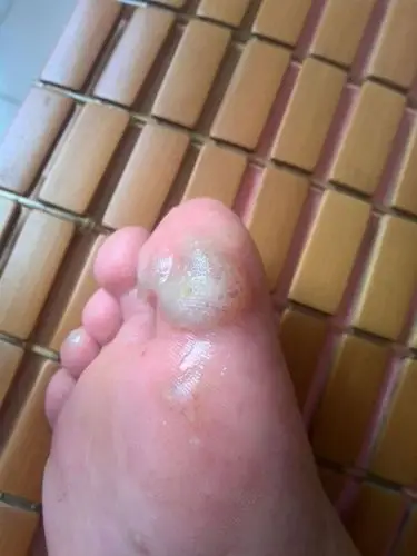 脚上肿了脓包怎么办