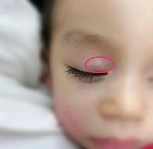 霰粒肿攻略:非手术康复