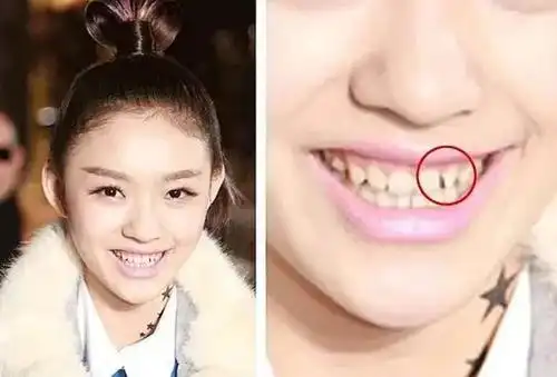 一般来说,正常人的牙齿都是淡黄色,少部分人可能天生牙白,包括明星