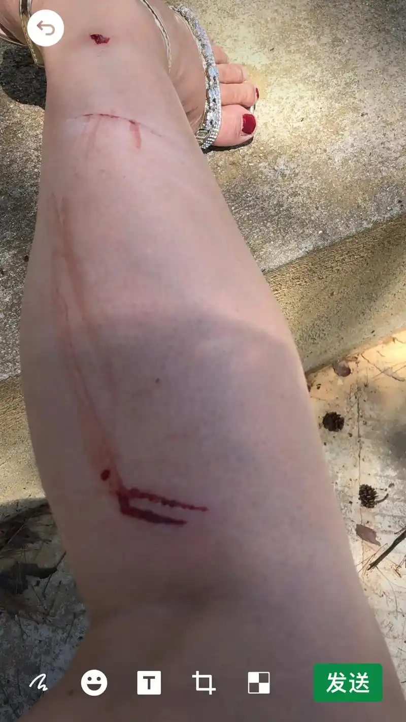 一不小心腿受伤了,看着流血掉皮的腿只有忍,熬过就好了,俗话说 - 抖音