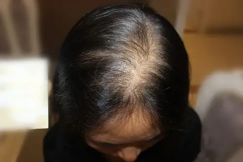 女孩子掉头发,用米诺地尔管用吗?_女性