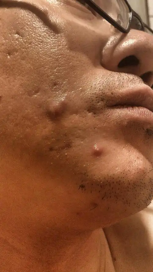 我的痘痘退了,但是留下很多色斑,还新增了几个结节,囊肿型.