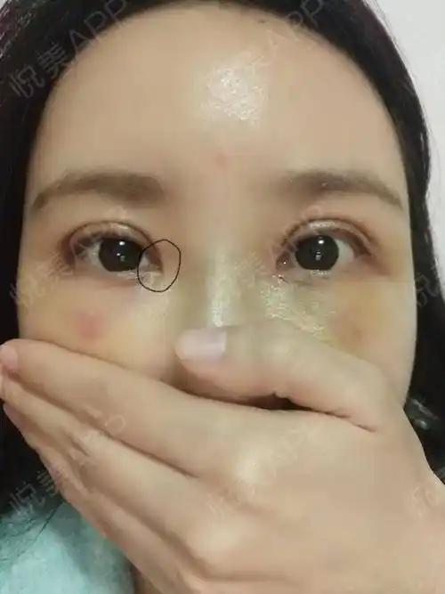 外切去眼袋术后3天_去眼袋术后3天_眼部整形术后3天_伤痛不过百日分享