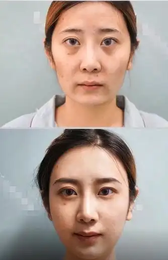 自体脂肪填充丰额头好吗,存活率高吗