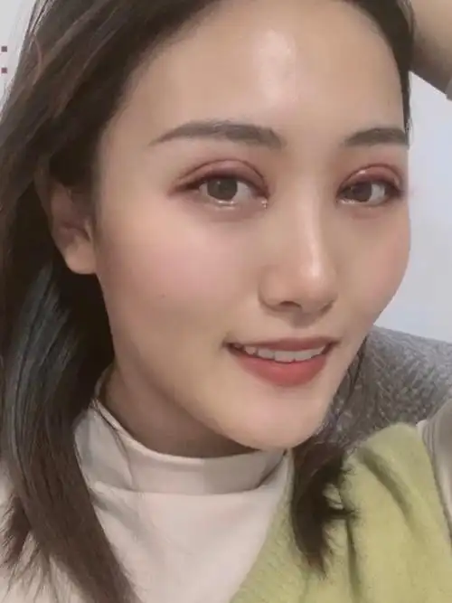 术后第1天做完全切双眼皮的第一天,可以看下眼部肿胀_圈子-新氧美容